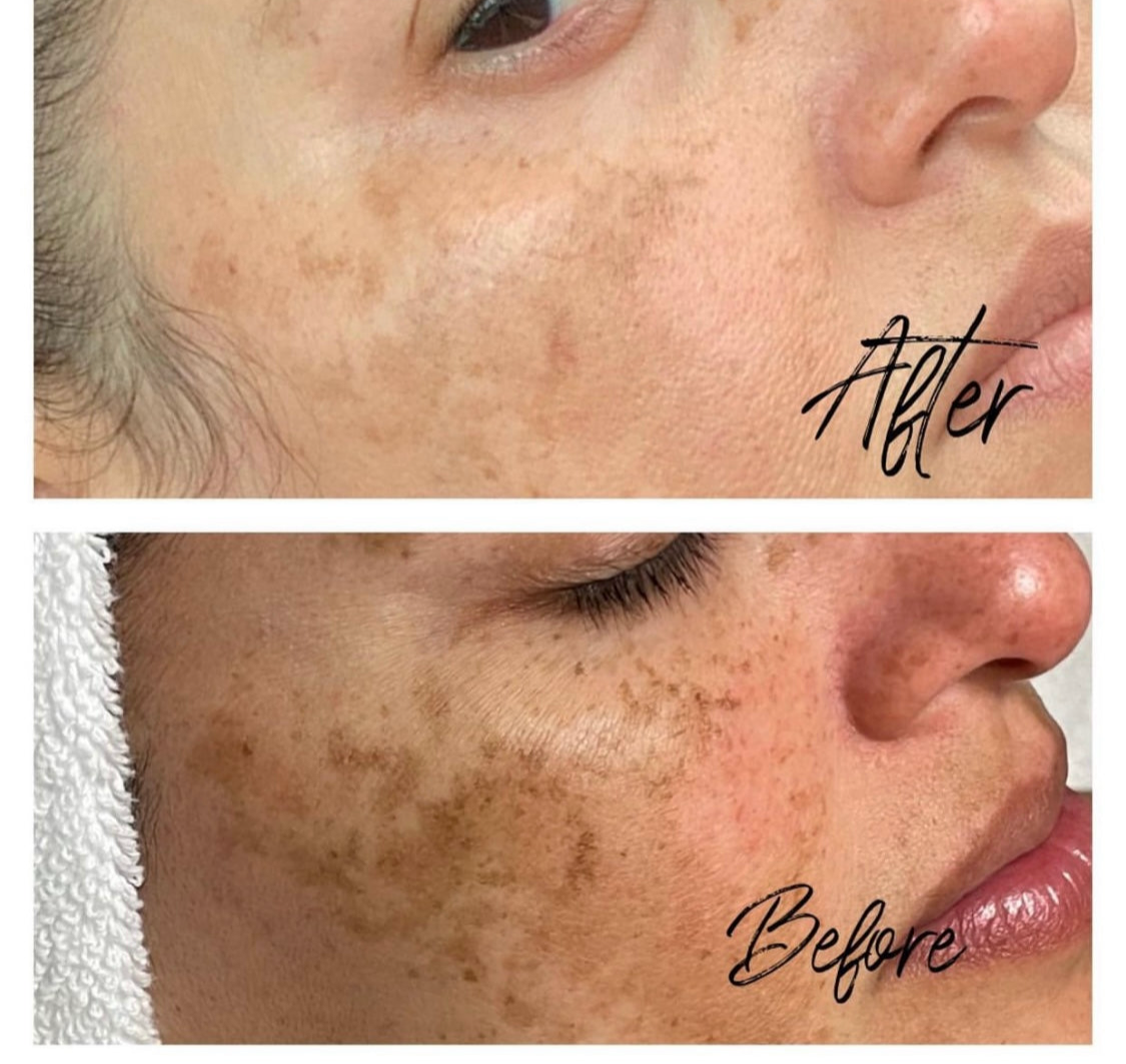 Skinmedica Rejuvenize Peel Treatment Professional Chemical Peel Kit! x1ct