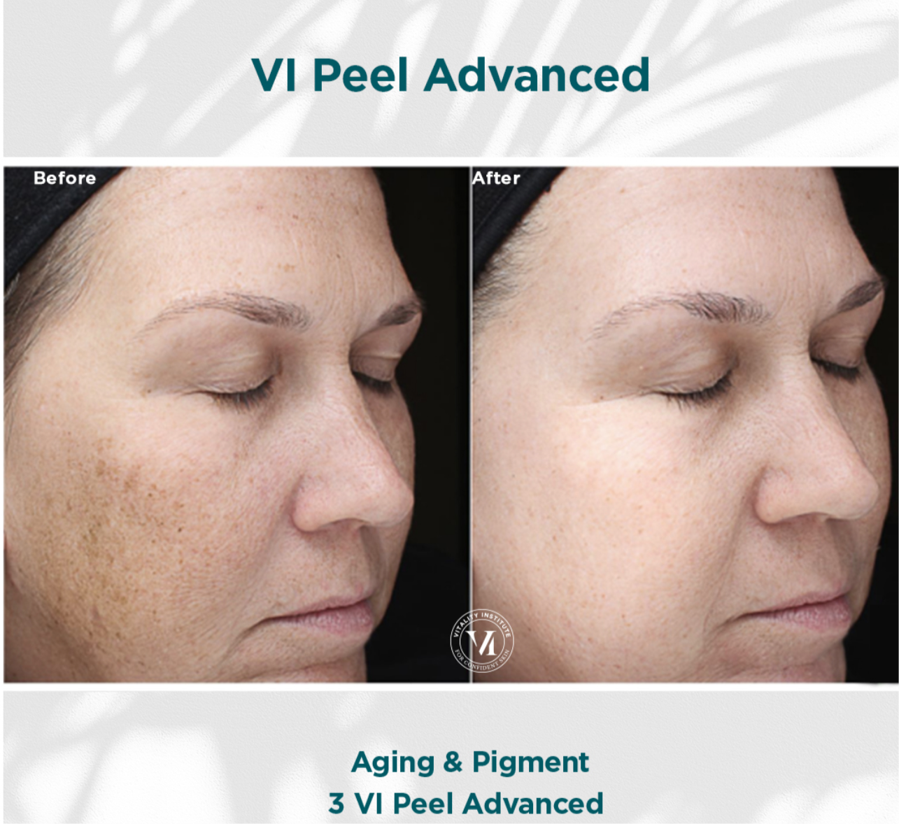 VI Peel Advanced