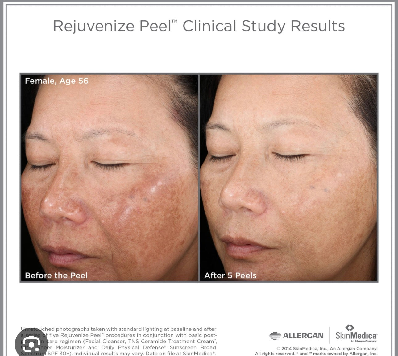 Skinmedica Rejuvenize Peel