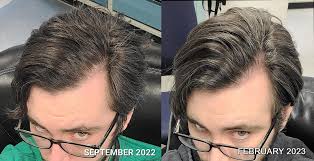 Minoxidl/ Dutasteride 30ml Hair Growth Solution Liquid Dropper Prescription