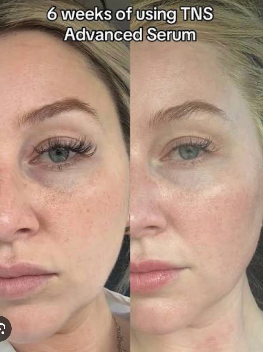 SkinMedica® TNS Advanced+ Serum – Advanced Growth Factor Anti-Aging Treatment