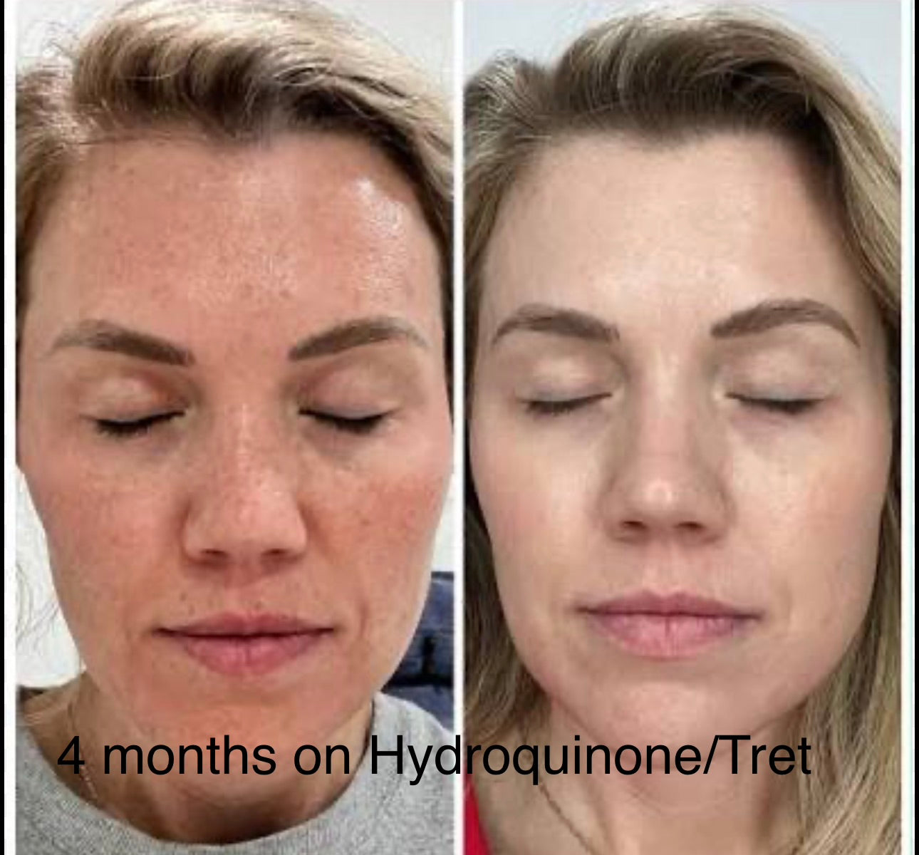 Prescription melasma cream by Hollywood Skin Club with hydroquinone and tretinoin triple combo cream powerful melasma dark spots treatment 