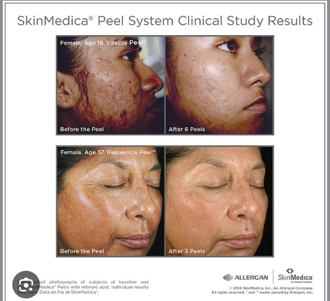 Skinmedica Vitalize Peel chemical peel professional At Home Treatment Chemical Peel Wrinkles Anti-Aging Pigment Melasma