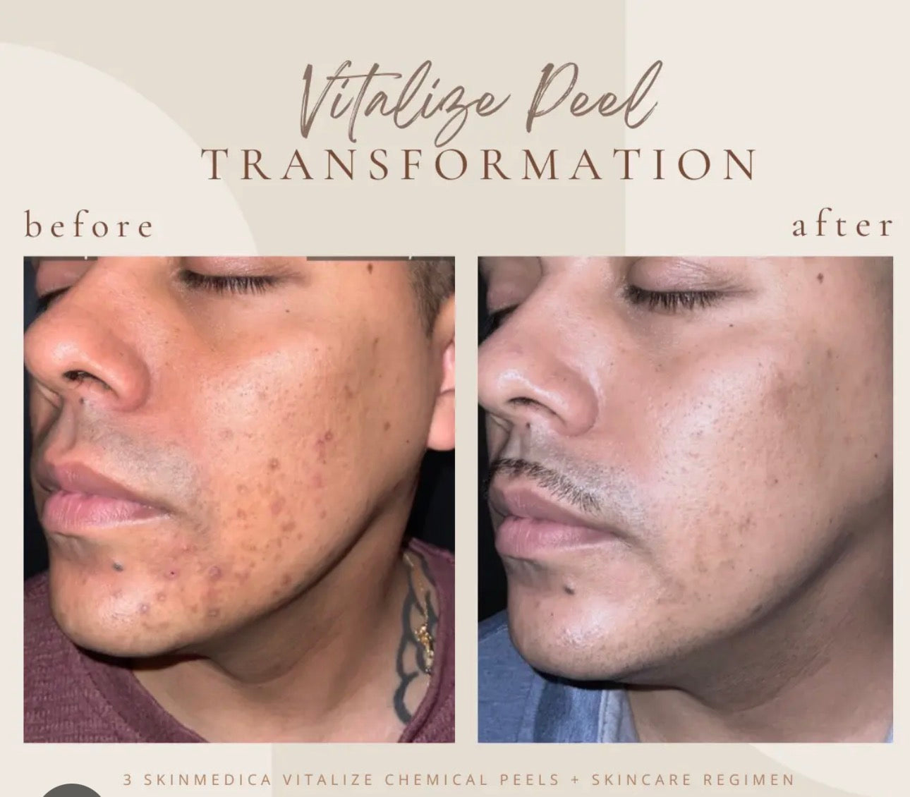 Skinmedica Vitalize Peel chemical peel professional At Home Treatment Chemical Peel Wrinkles Anti-Aging Pigment Melasma