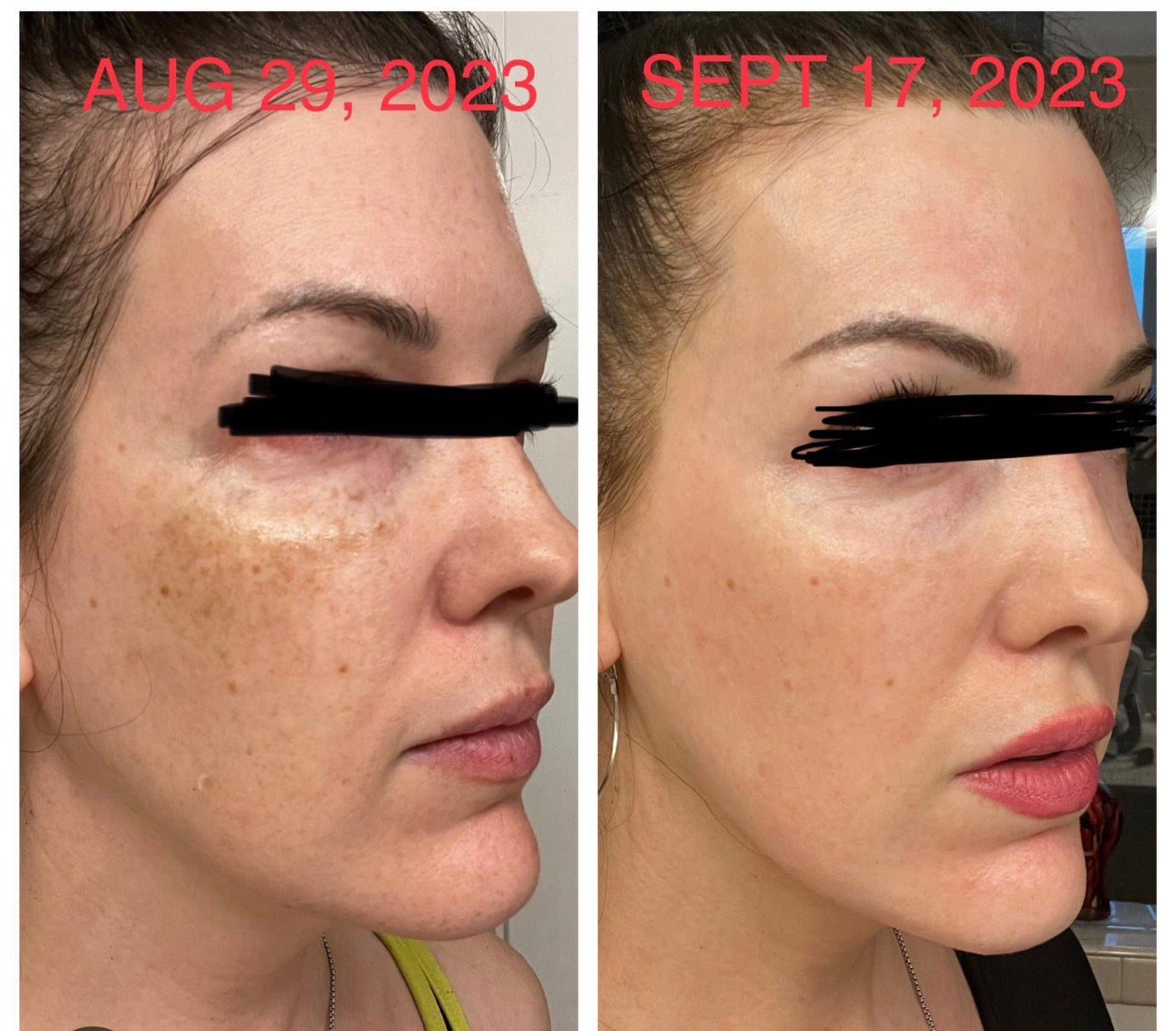 Prescription skin brightening cream for dark spots and melasma medical grade topical RX