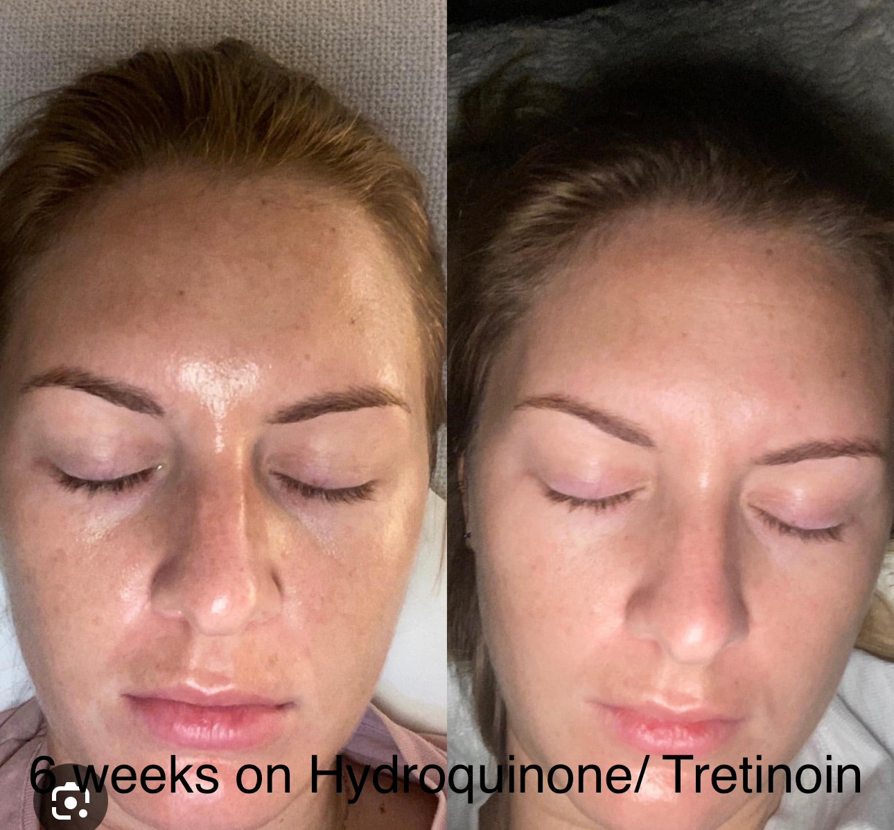 Medical grade hyperpigmentation cream hydroquinone and tretinoin Hollywood Skin Club
