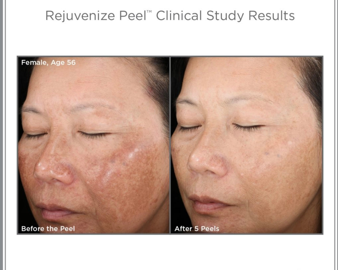 Skinmedica Rejuvenize Peel Treatment Professional Chemical Peel Kit!  x1ct