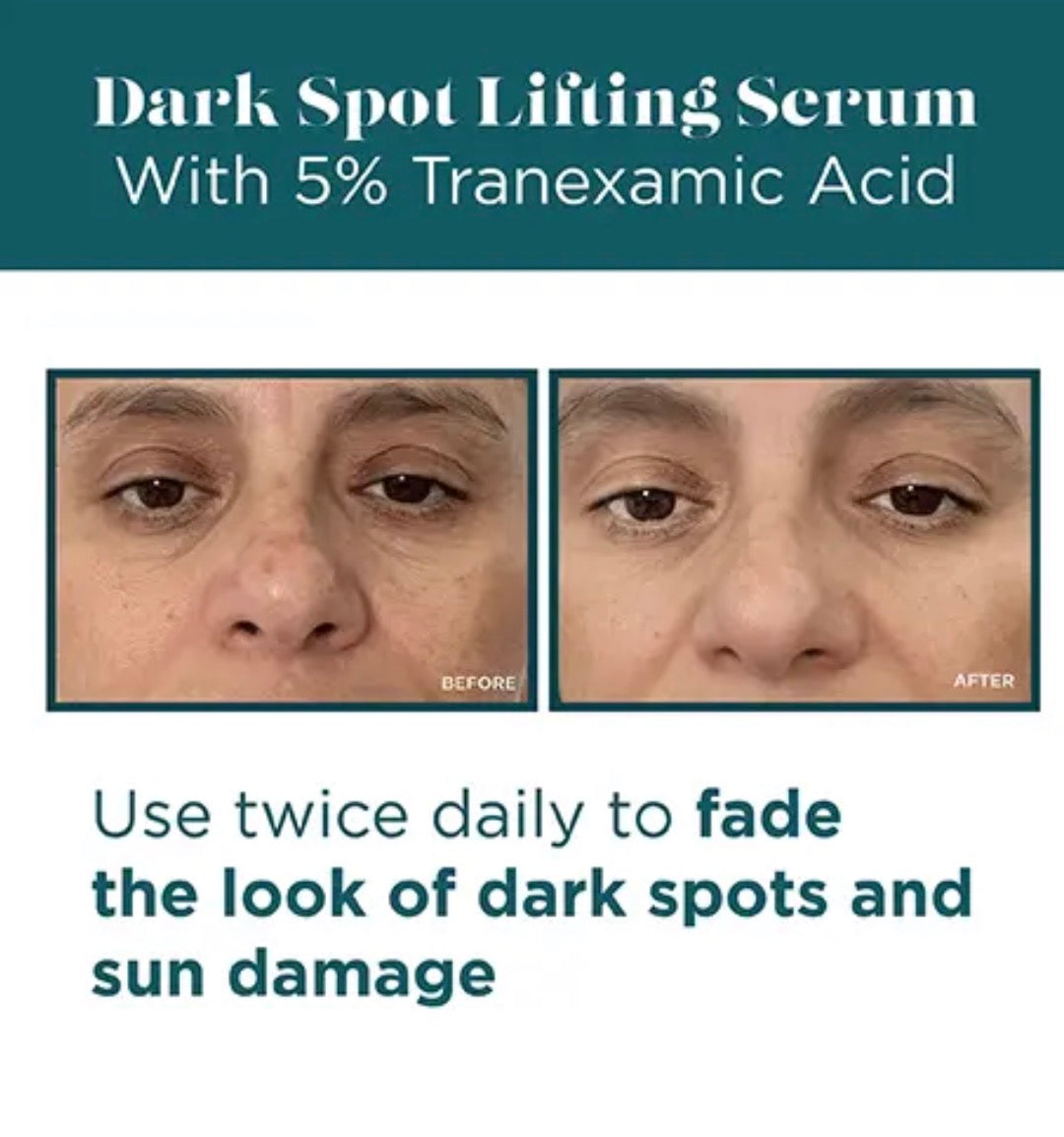VI Derm Dark Spot Lifting Serum Treatment Cream with 5% Tranexamic Acid 50ml