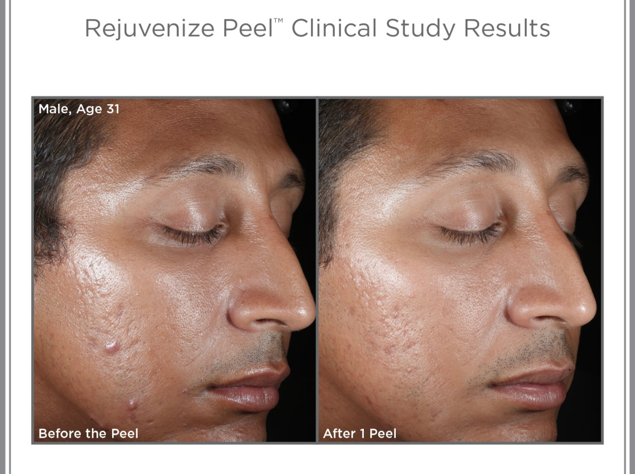 Skinmedica Rejuvenize Peel Treatment Professional Chemical Peel Kit!  x1ct