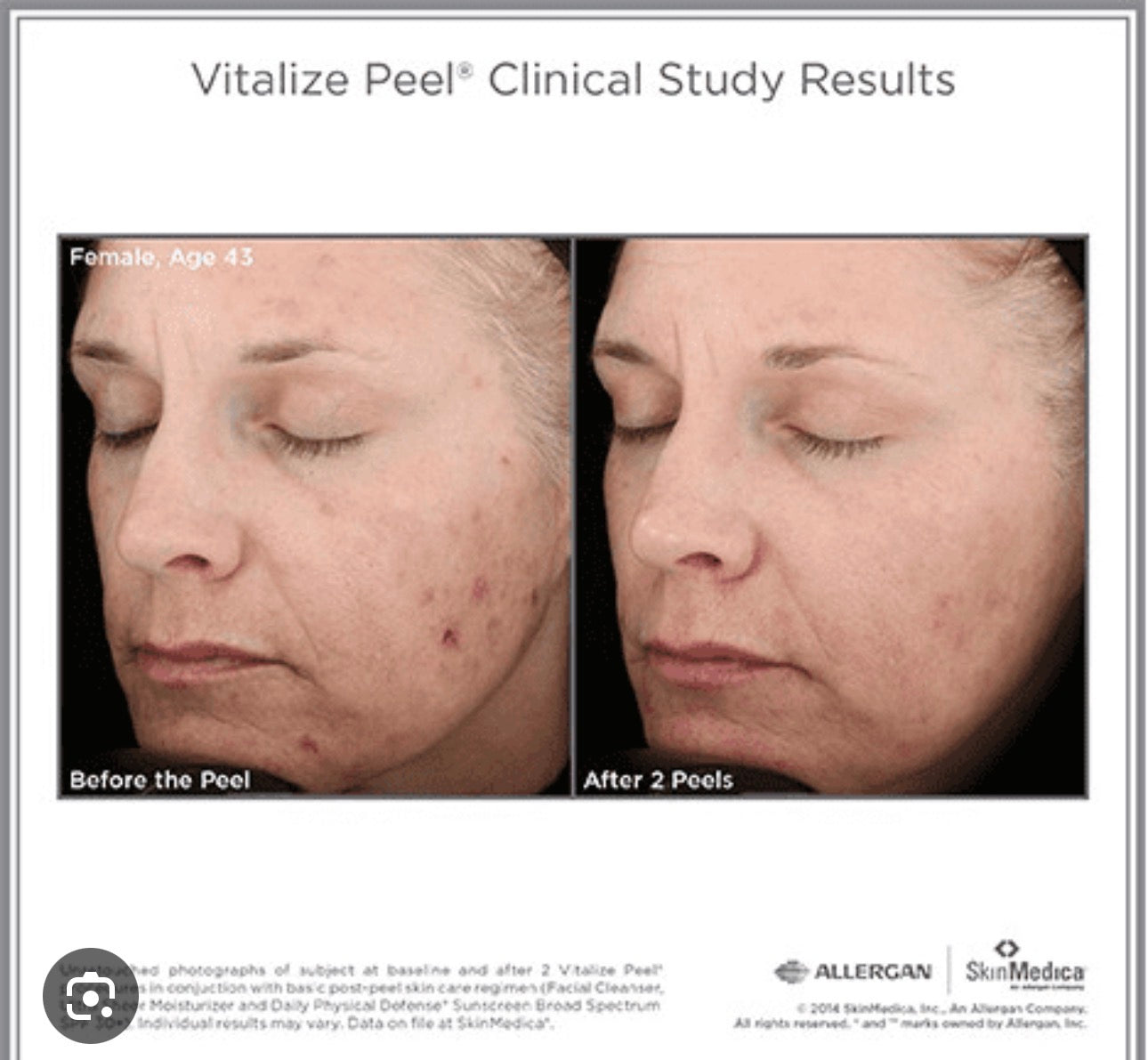 Skinmedica Vitalize Peel chemical peel professional At Home Treatment Chemical Peel Wrinkles Anti-Aging Pigment Melasma