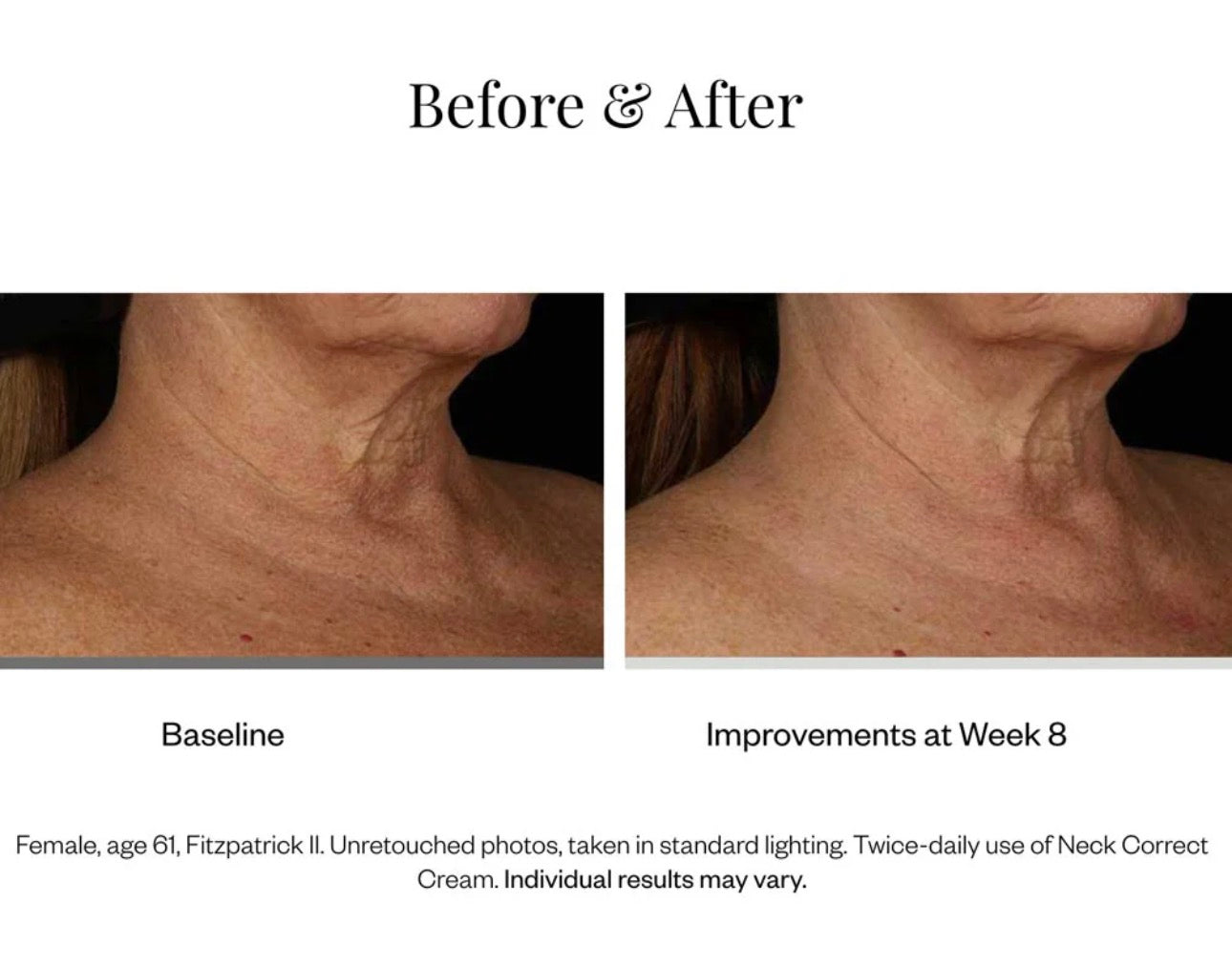 Skinmedica Neck Correct Cream 2oz Neck/ Chest/ Décolleté Tightening Lifting Anti-aging Cream 8 week Results! Chicken Neck