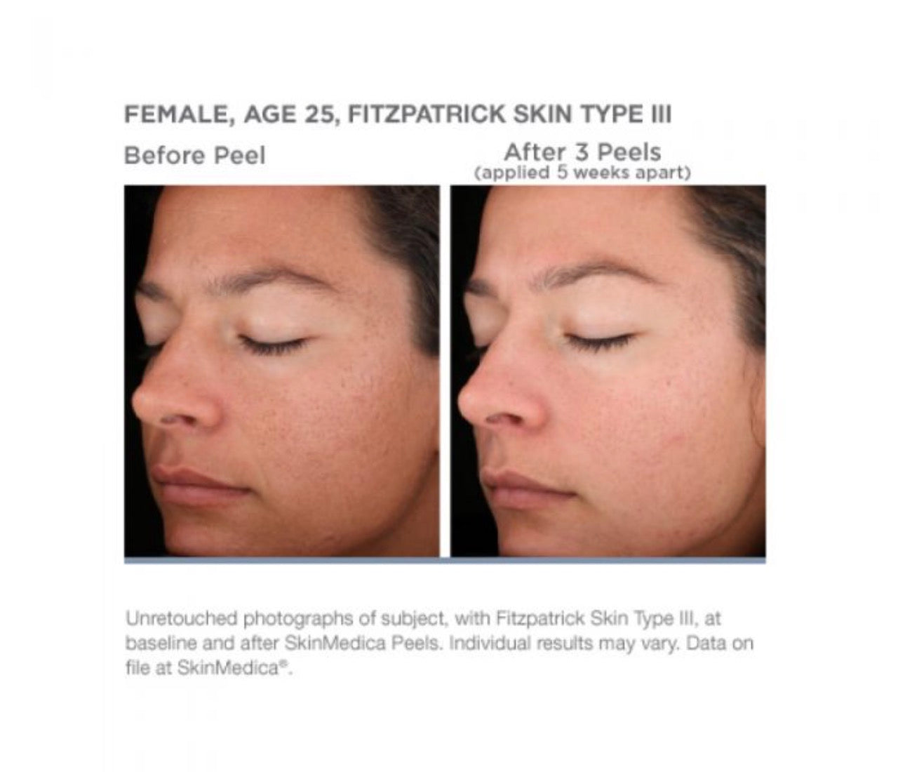 Skinmedica Rejuvenize Peel