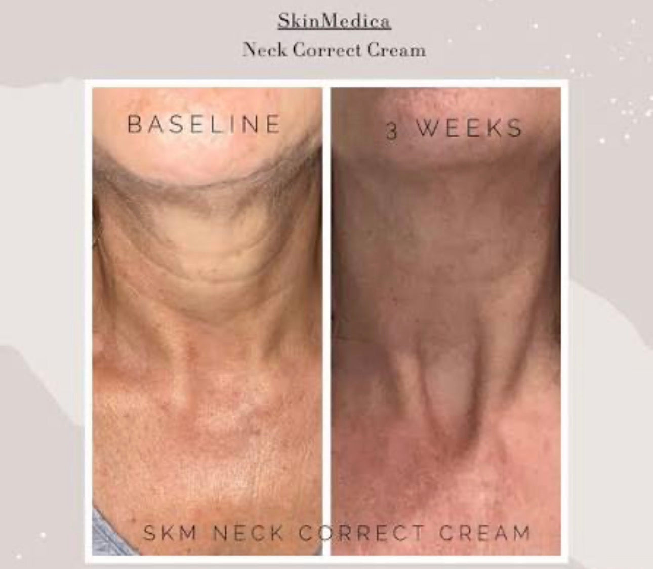 Skinmedica Neck Correct Cream 2oz Neck/ Chest/ Décolleté Tightening Lifting Anti-aging Cream 8 week Results! Chicken Neck